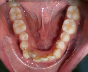 Traitement par gouttière Invisalign cas n°2 début de traitement