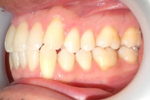 Traitement par gouttière Invisalign cas n°2 fin de traitement